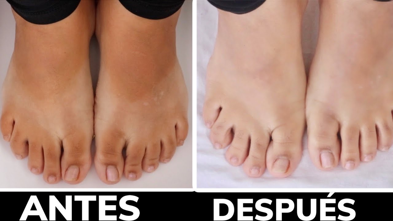 como desmanchar los pies quemados por el sol